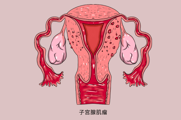 子宫腺肌症为什么会影响怀孕？如何预防呢？.jpeg